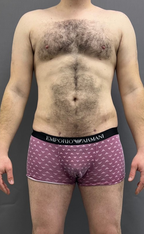 Male transformation after